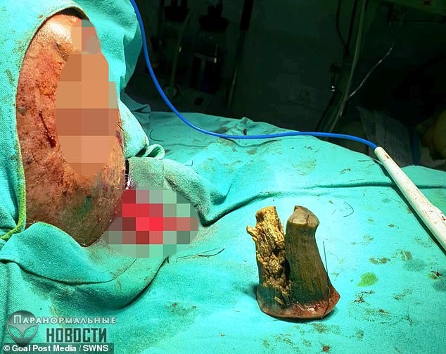 На лбу пожилого индийца вырос &laquo;дьявольский&raquo; рог 