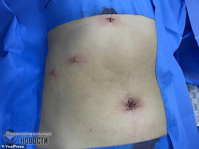 В Таиланде из пациентки вытащили почти 2 тысячи желчных камней 