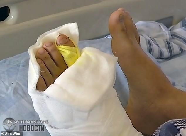В Китае прооперировали мужчину с 9 пальцами на ноге 
